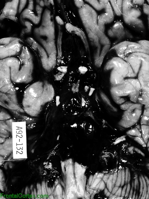 Subarachnoid Hemorrhage, ventral surface of brain